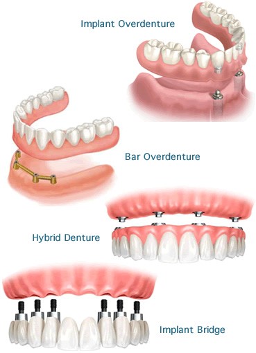 Zirconium Dentures Midwest WY 82643